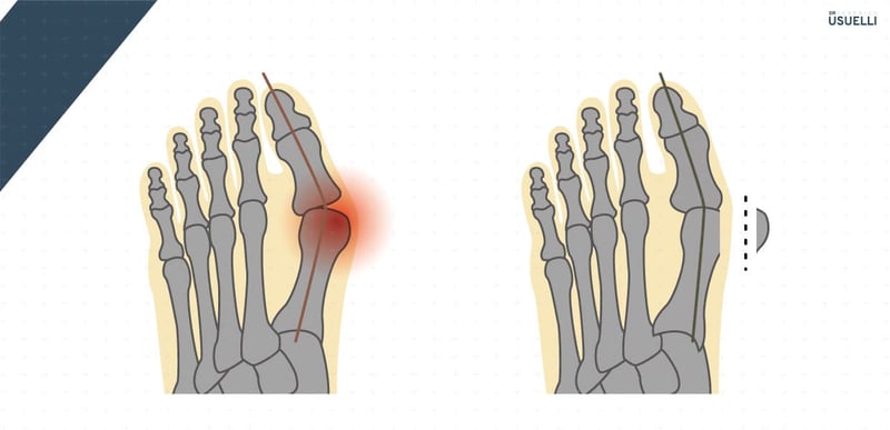 Illustrazione che esemplifica l'intervento per alluce valgo con tecnica MICA.