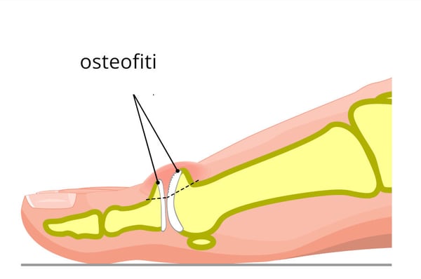 Illustrazione che mostra un esempio di osteofiti causati dalla presenza di un alluce rigido.