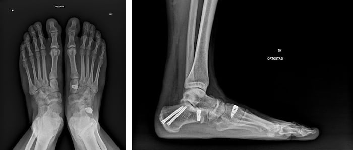 Imaging di un'osteotomia per piede piatto.
