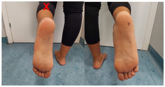 piede piatto corretto 1