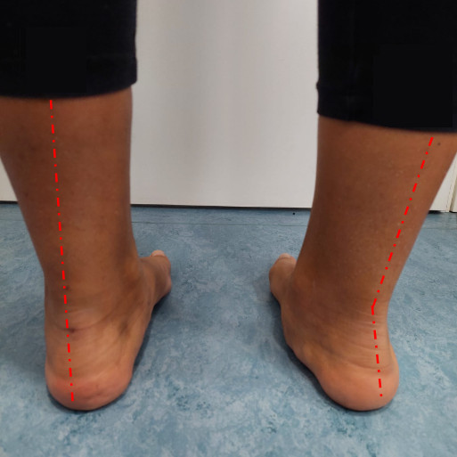 Foto dei piedi di un paziente con piede valgo non trattato sul lato destro e piede valgo corretto chirugicamente sul lato sinistro.