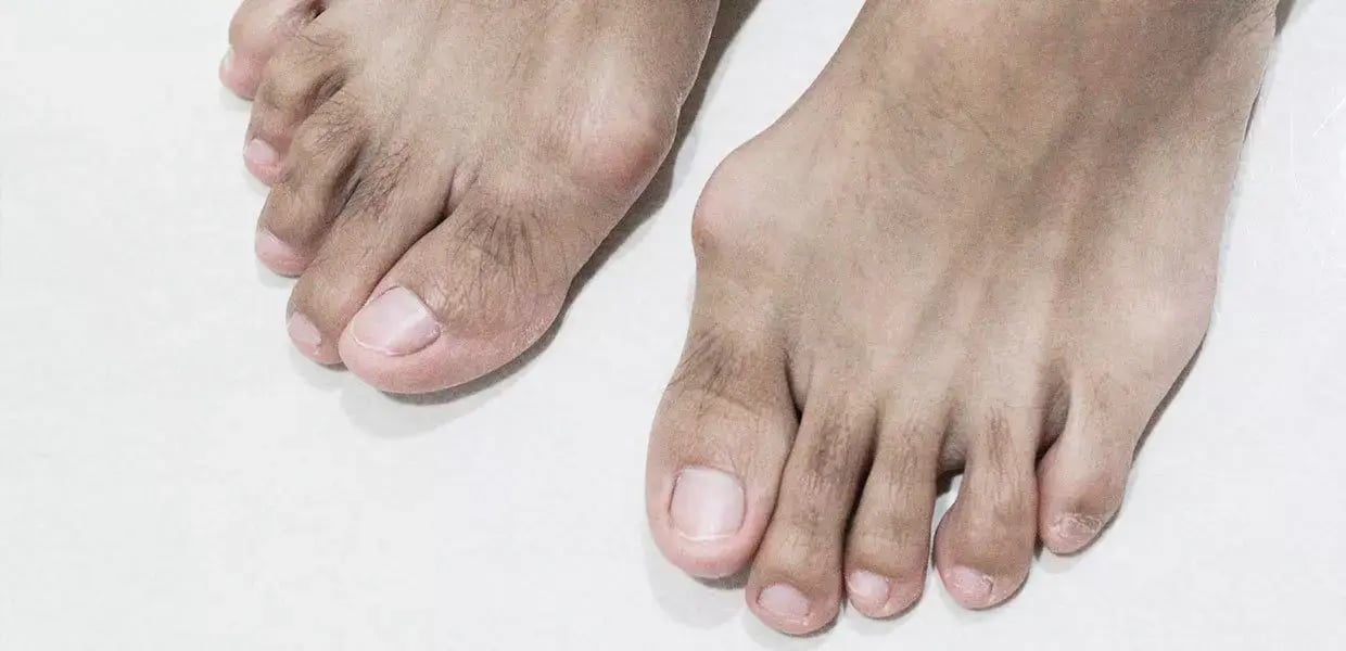piedi-con-alluce-valgo-maschili-min