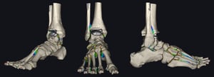 Elaborazioni 3D di TAC in carico per il planning preoperatorio della revisione di una protesi BOX.