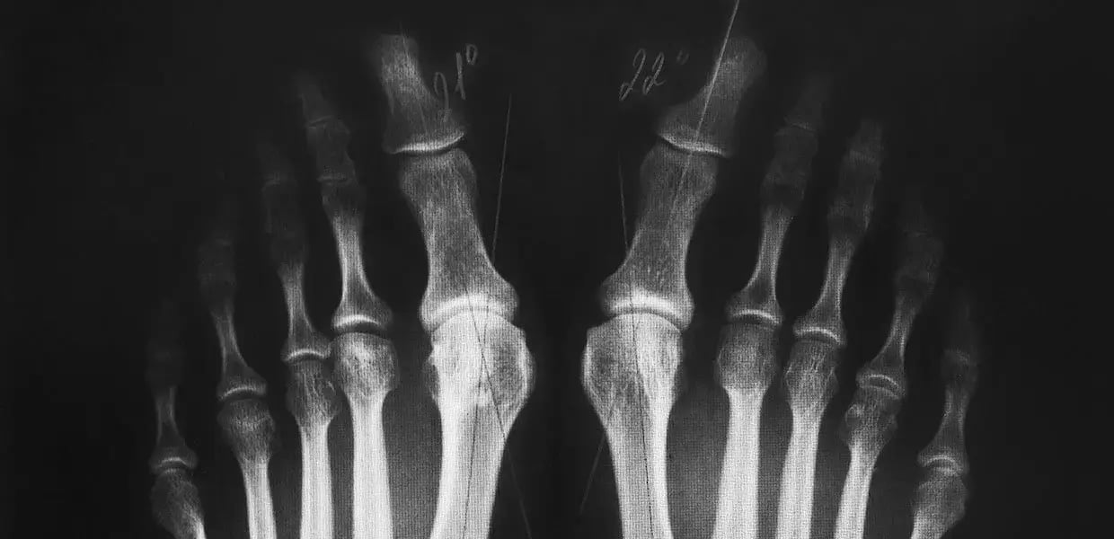 radiografia-dell-alluce-valgo-due-piedi-min