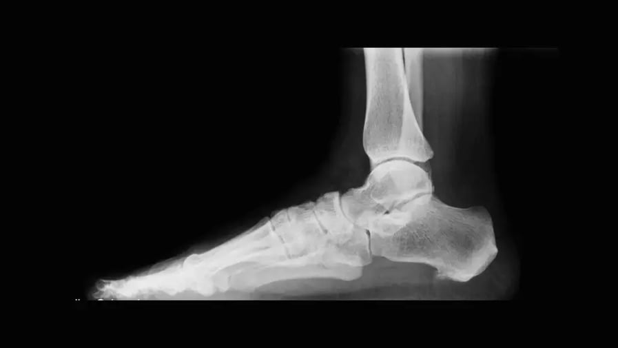 radiografia-piede-in-carico