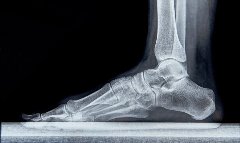 Radiografia del piede in carico, necessaria prima di poter procedere a un intervento per fascite plantare.
