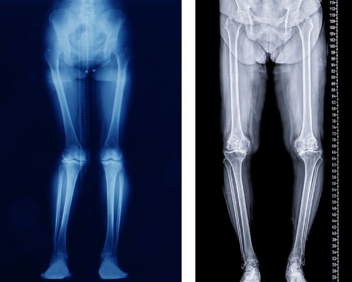 Due radiografie che mostrano pazienti con ginocchia valghe e vare.