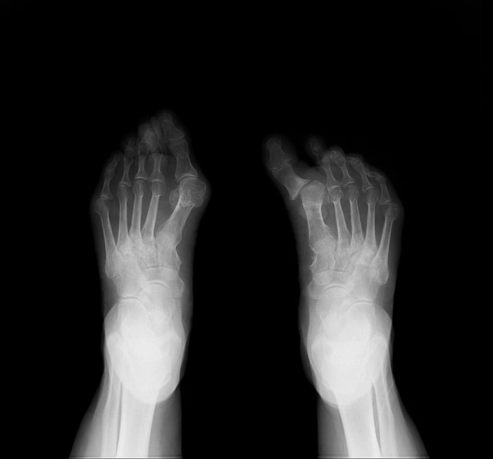 Radiografia di due piedi che mostrano alluci con varismo e valgismo.