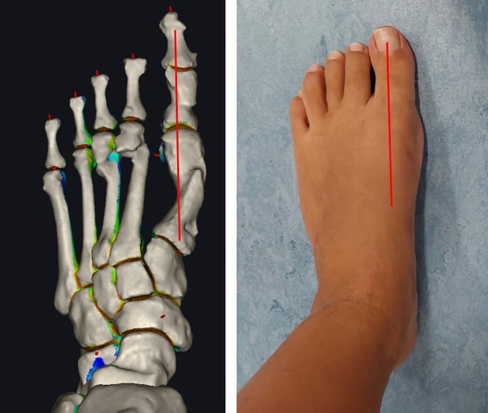 Ricostruzione 3D di un piede affiancata da una foto post intervento per alluce valgo, che mostrano entrambe la correzione ottenuta.