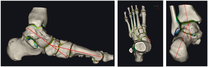ricostruzione 3d piede piatto pre-intervento
