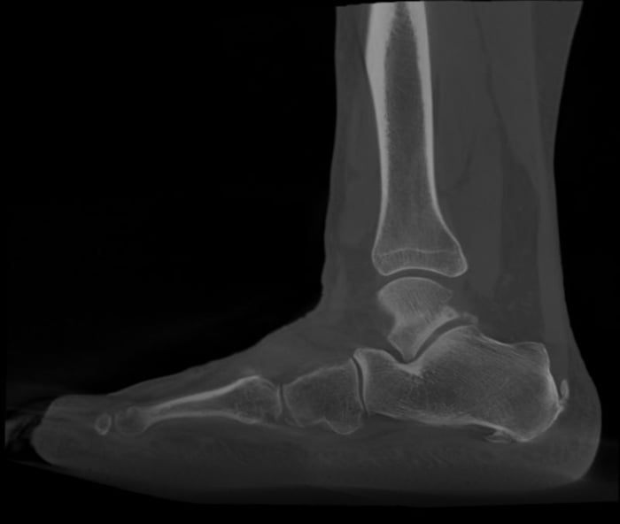 Tac che mostra il piede di un paziente con fascite plantare e con spina calcaneare.