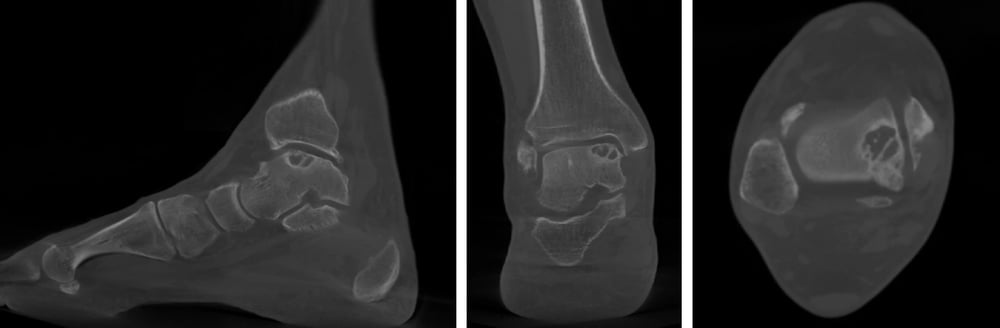 TAC in carico per intervento protesi 3D