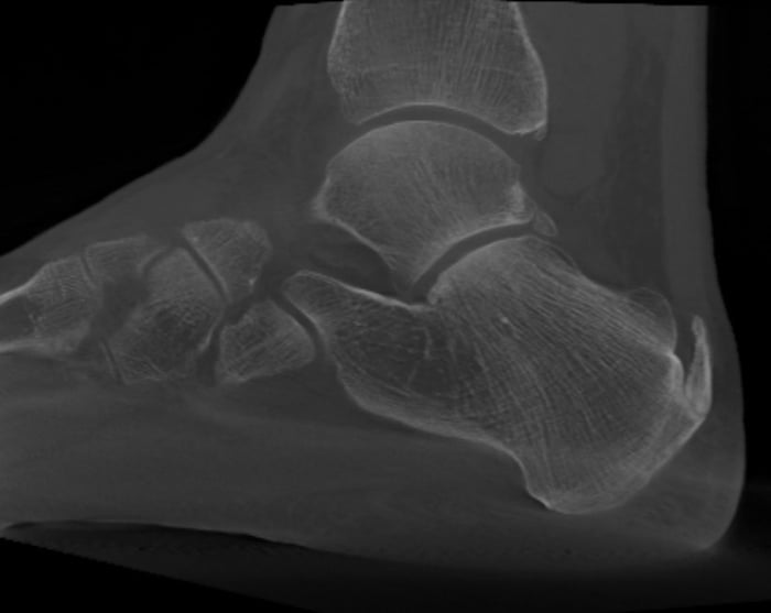 Tac in carico relativa a un caso di tendinopatia achillea inserzionale.