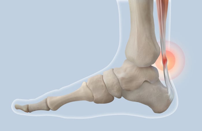 Illustrazione che mostra la posizione di una tendinopatia achillea non inserzionale.
