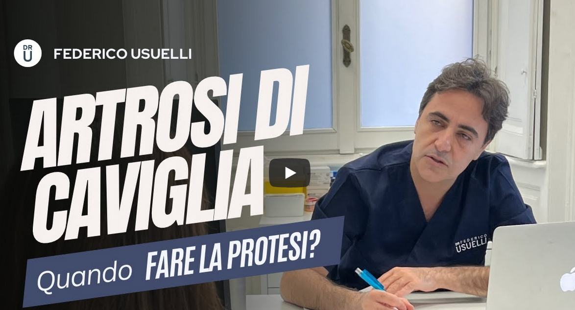 Thumbnail per il video sulla protesi in caso di artrosi di caviglia.