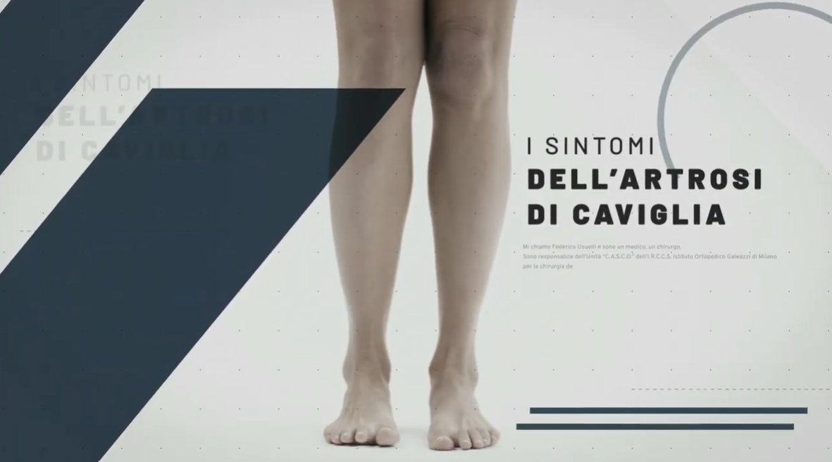 Thumbnail del video sui sintomi dell'artrosi di caviglia.