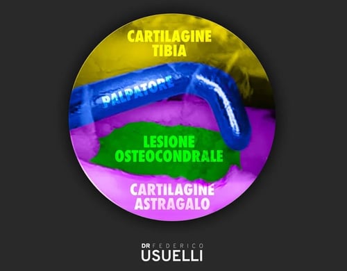 Immagine che mostra la posiziona di una lesione osteocondrale alla cartilagine caviglia e l'attrezzo chirurgico usato per l'intervento.