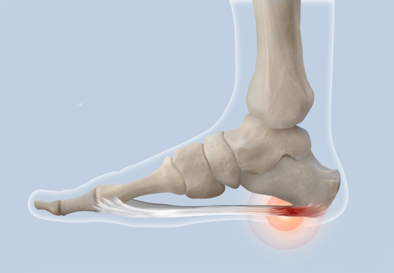 Visuale anatomica della zona in cui si colloca l'infiammazione e su cui viene effettuato l'intervento per fascite plantare.