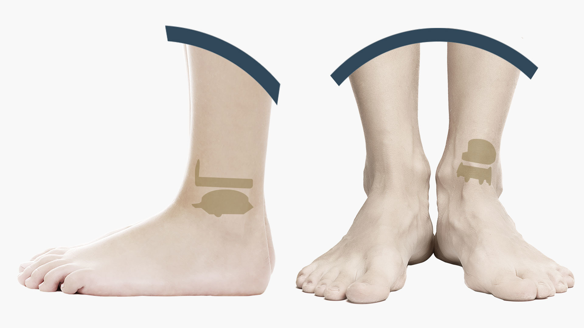 Protesi di caviglia mobile bearing frontale e laterale